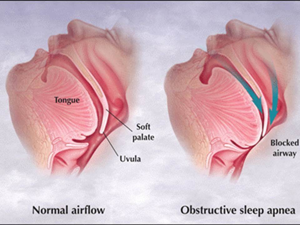 what-is-obstructive-sleep-apnea